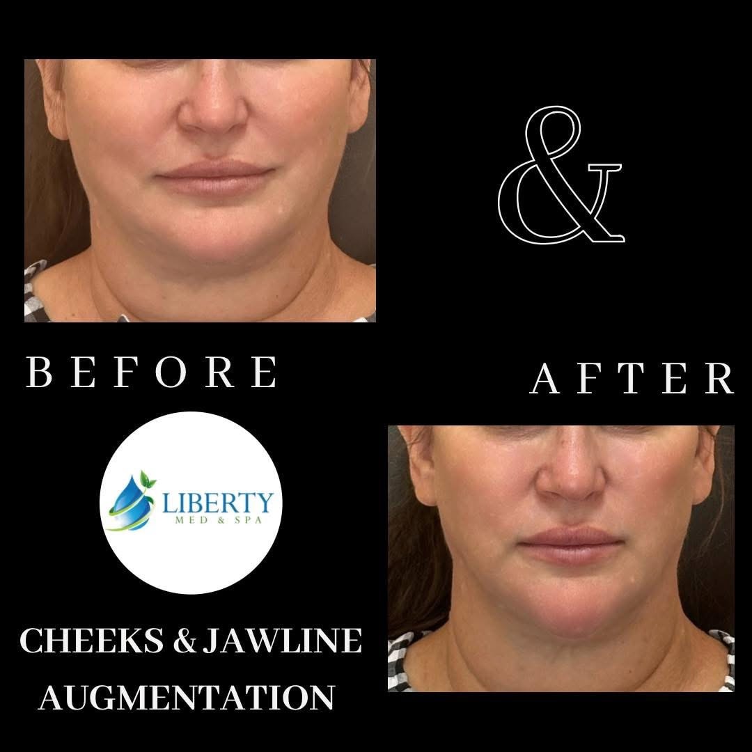Before and after cheeks and jawline augmentation results at Liberty Med & Spa