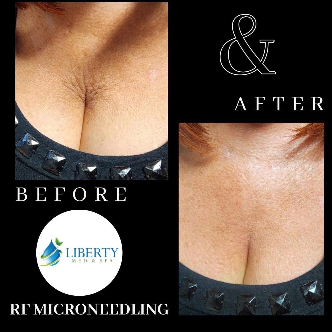 Before and after RF Microneedling décolletage skin tightening results at Liberty Med & Spa