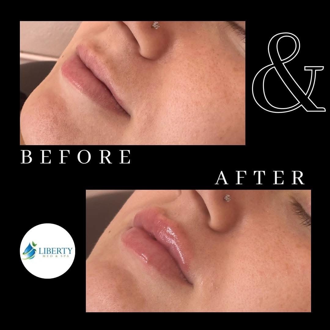 Before and after lip augmentation results at Liberty Med & Spa