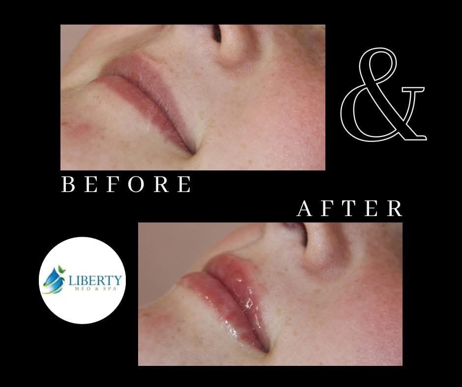 Before and after forehead wrinkle treatment results at Liberty Med & Spa