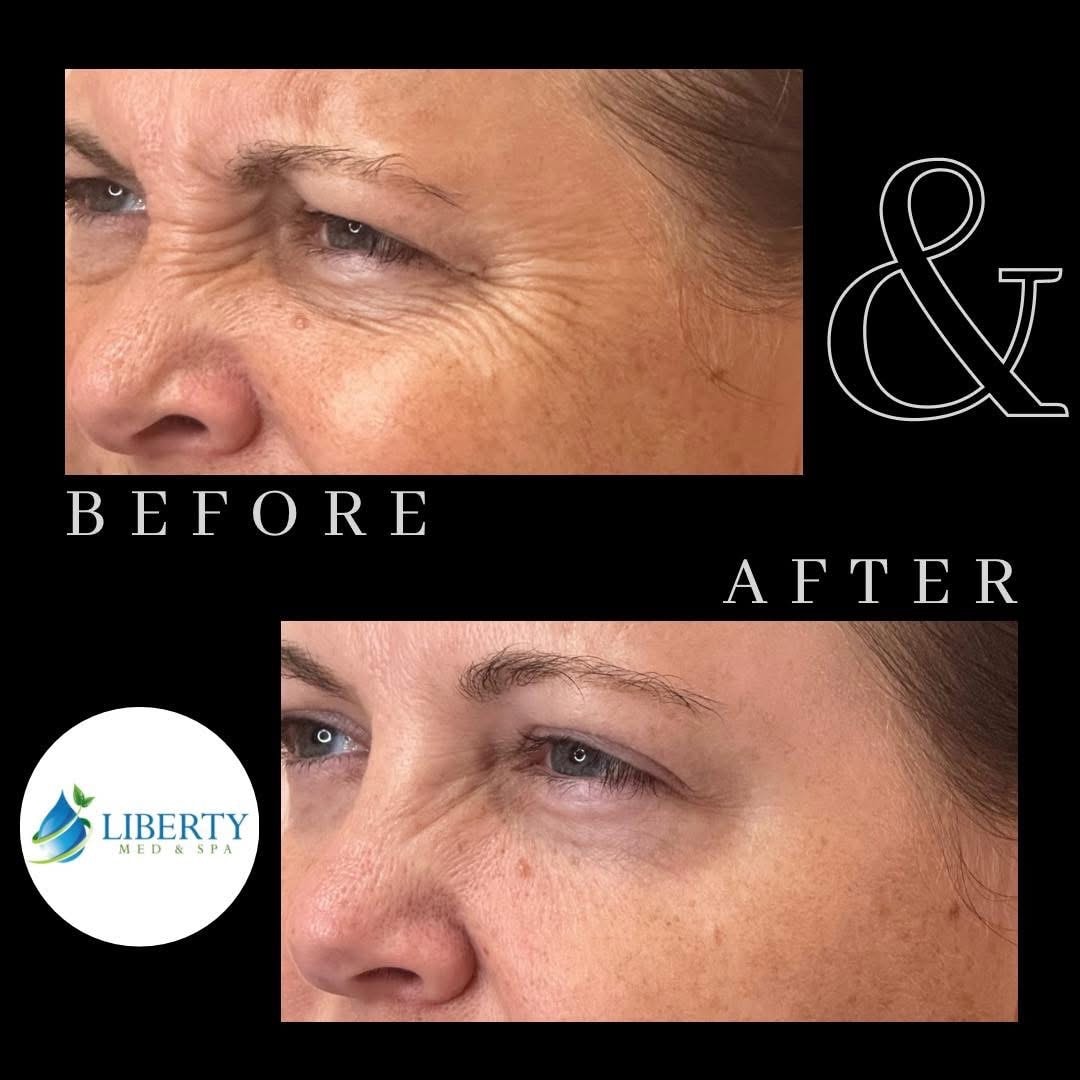 Before and after crow's feet and eye area wrinkle treatment results at Liberty Med & Spa