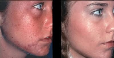 Before and after acne and skin texture treatment results at Liberty Med & Spa