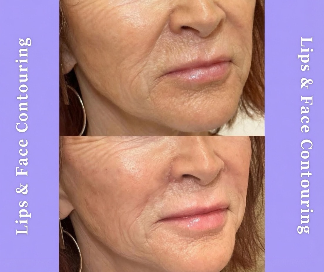 Before and after lips and face contouring results at Liberty Med & Spa