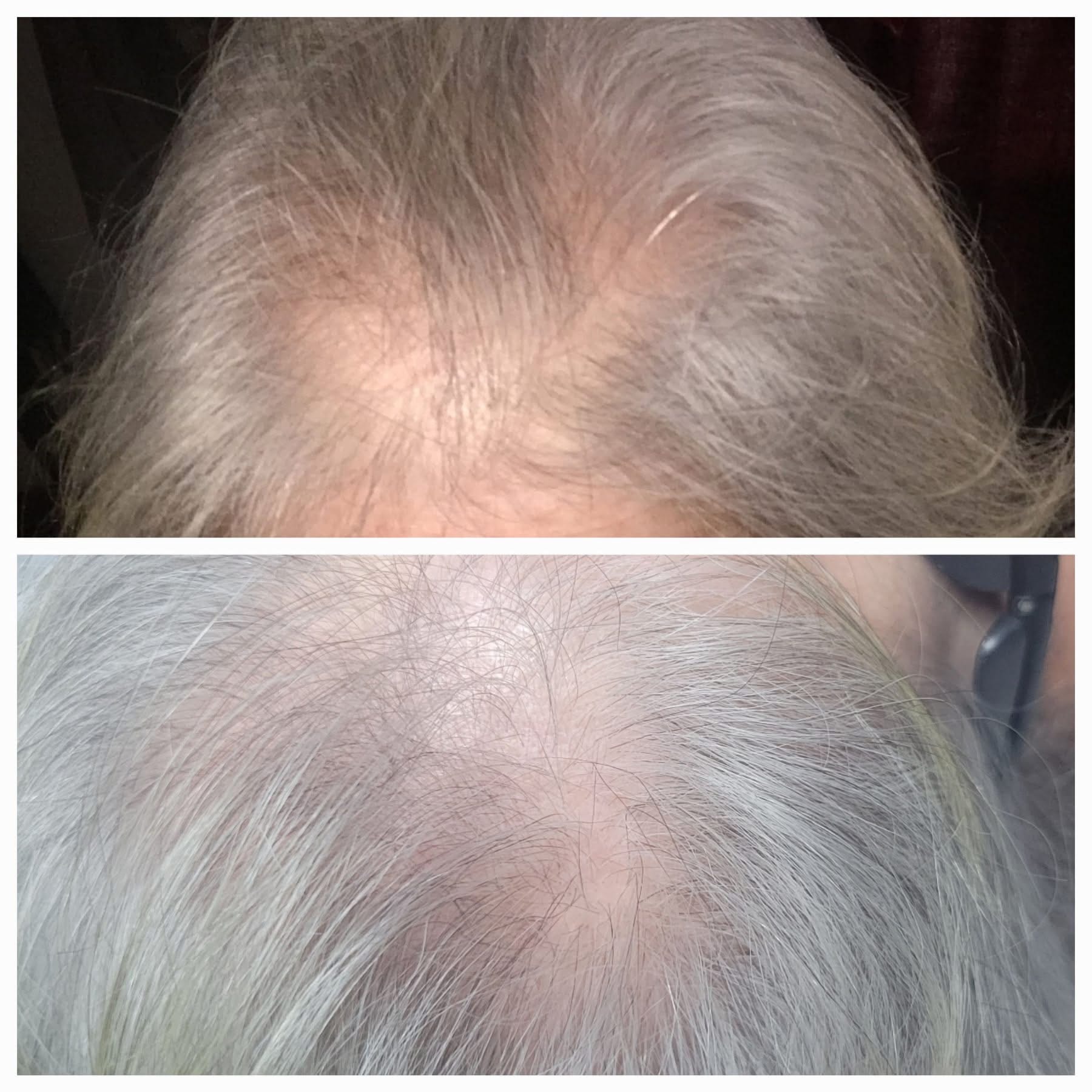 Hair Restoration