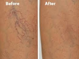 Sclerotherapy