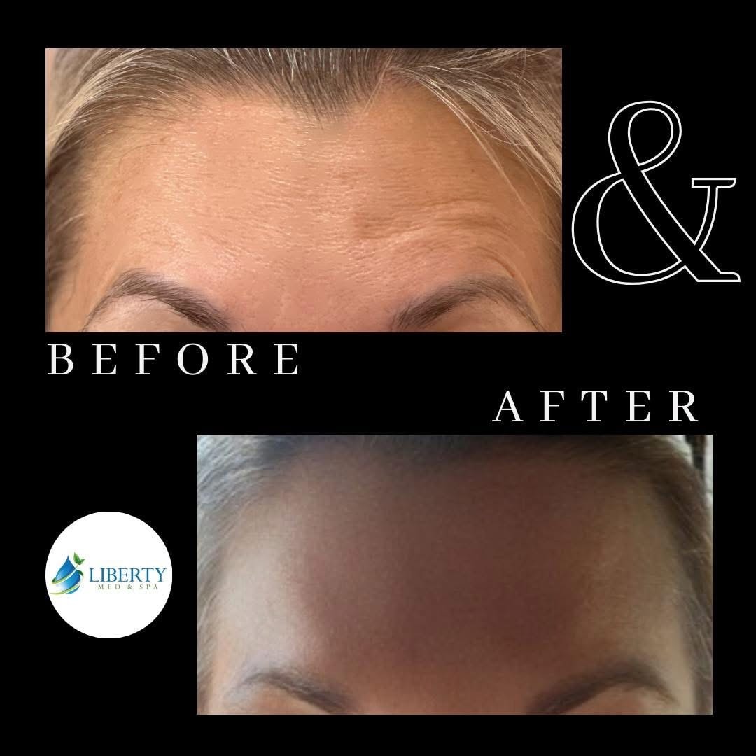 Before and after treatment results at Liberty Med & Spa