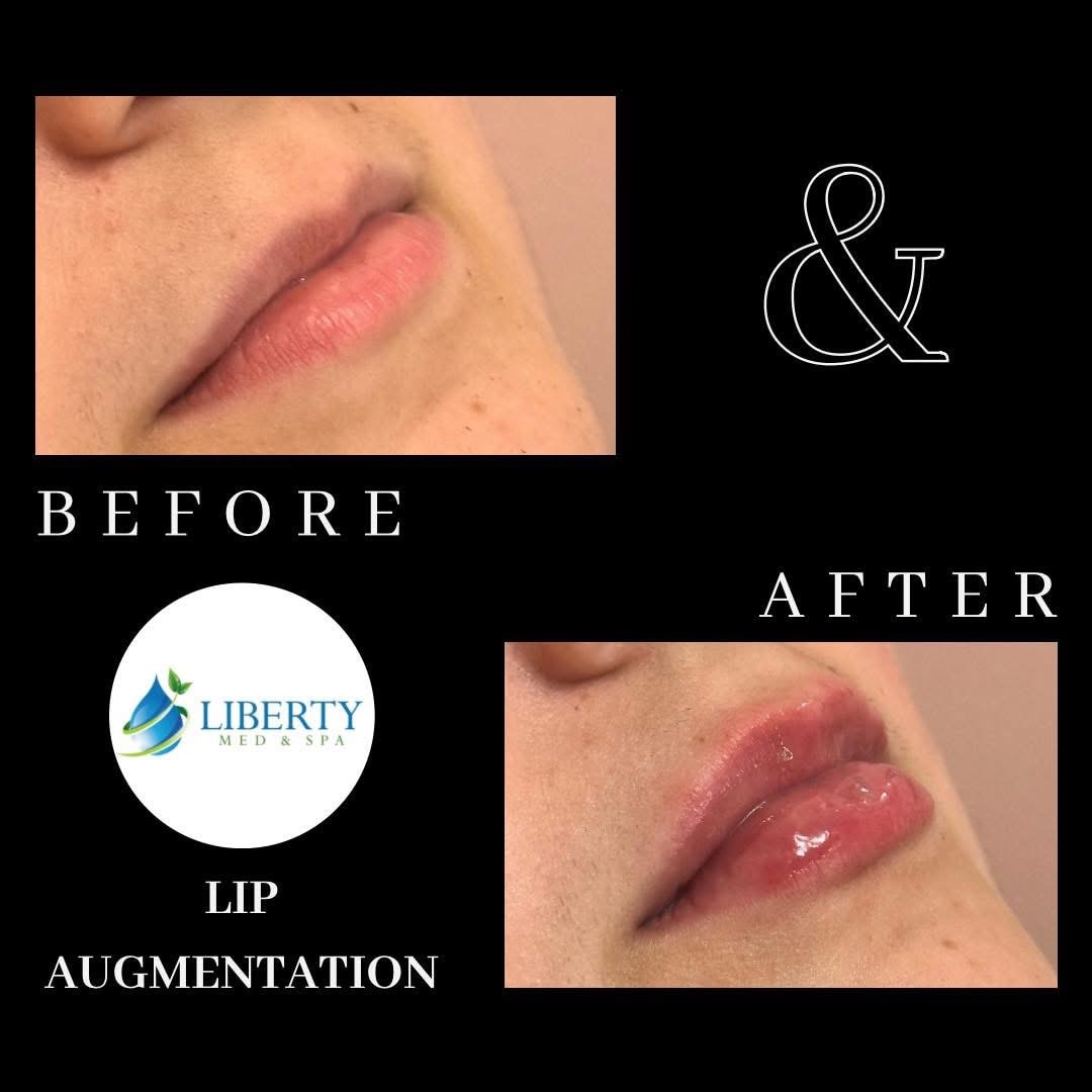 Before and after lip augmentation results at Liberty Med & Spa